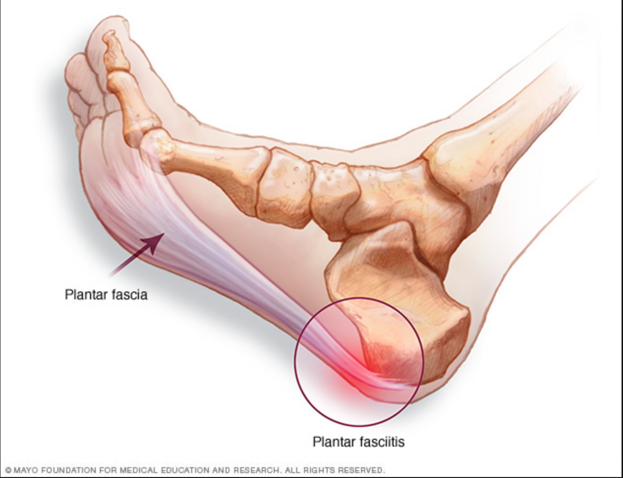 4 Strategies to Give Your Feet A Leg Up Against Plantar Fasciitis, Blog